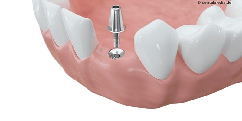 Forschungsprojekt Uni Wuppertal: Wie lange halten Implantate?