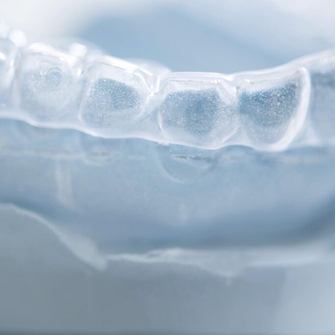 Farblose Aufbissschiene gegen Zähneknirschen