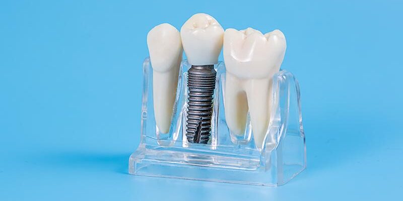 Aus welchem Material bestehen eigentlich Zahnimplantate?